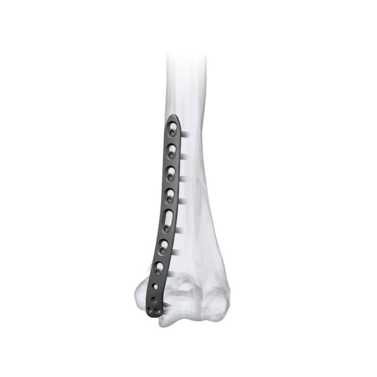 Posterolateral Distal Humerus Locking Plate 3.5 & 2.7 MM Without Lateral Support for Distal Humerus Fracture Fixation - Titanium and Stainless Steel