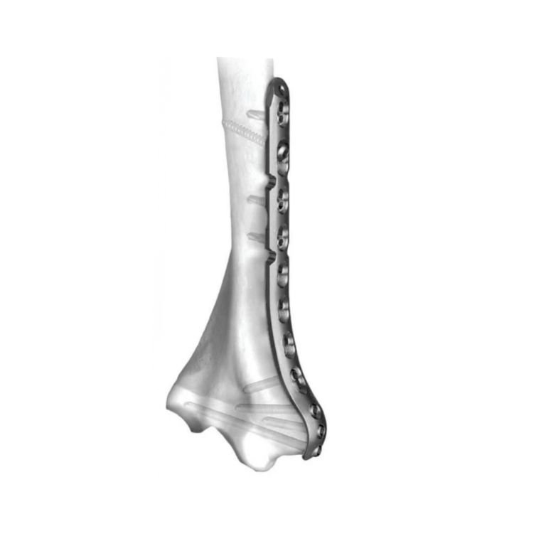 Metaphyseal Medial Distal Humerus Locking Plate 3.5 MM – Anatomically Contoured for Precision Fixation