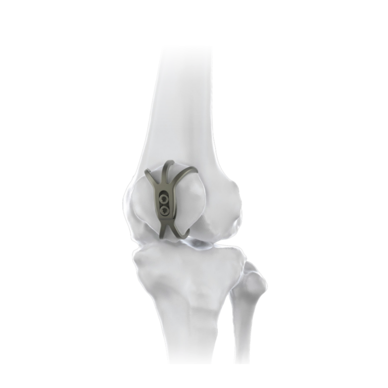 Patella Hook Plate