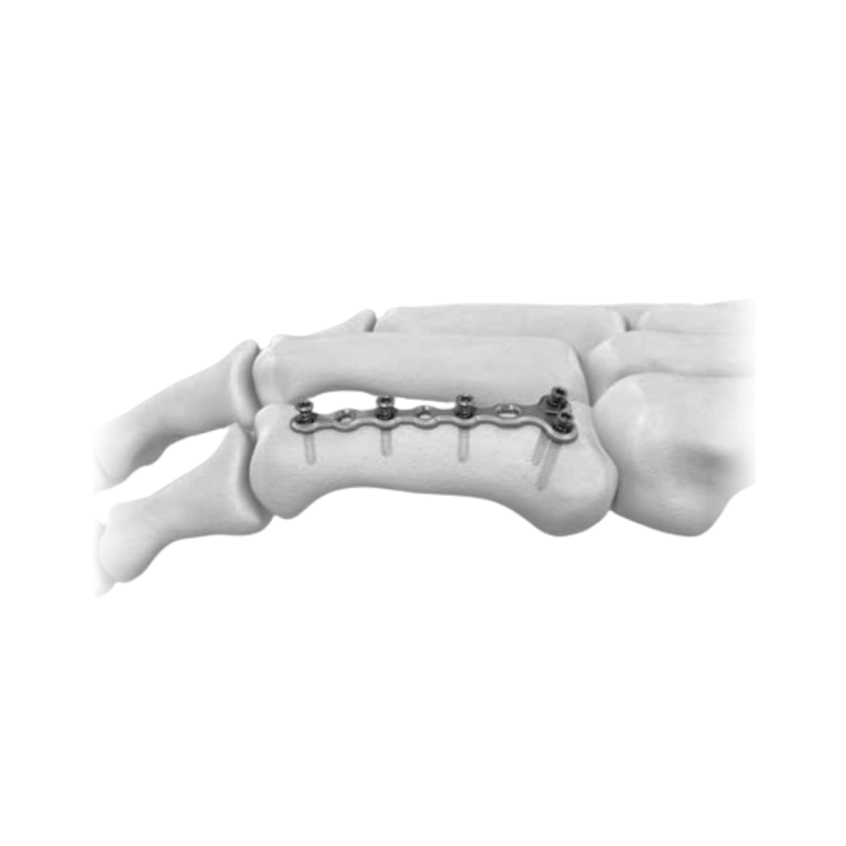 Condylar LCP Ø2.0&2.4MM