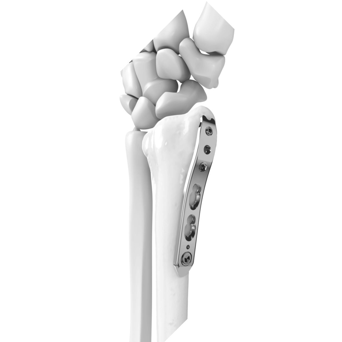 Distal-Radius-Straight-banner-1024x768