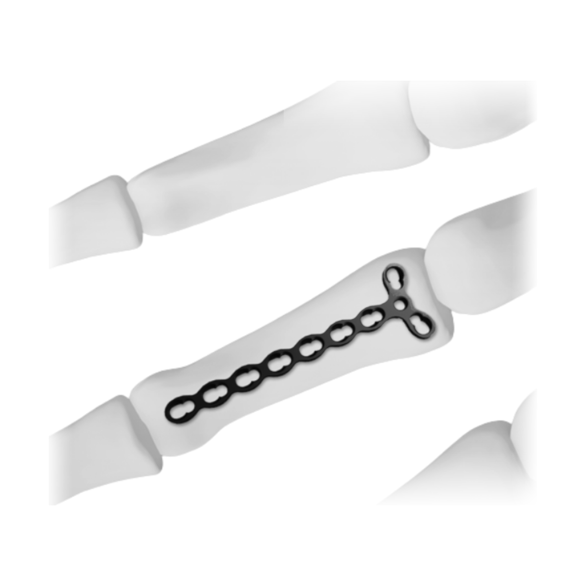 Ø2.4MM Y-adaption LCP2