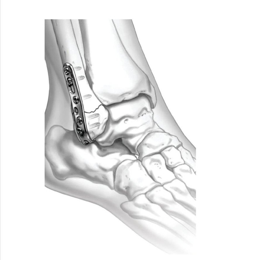 Ø3.5MM Ankle Hook LCP 2