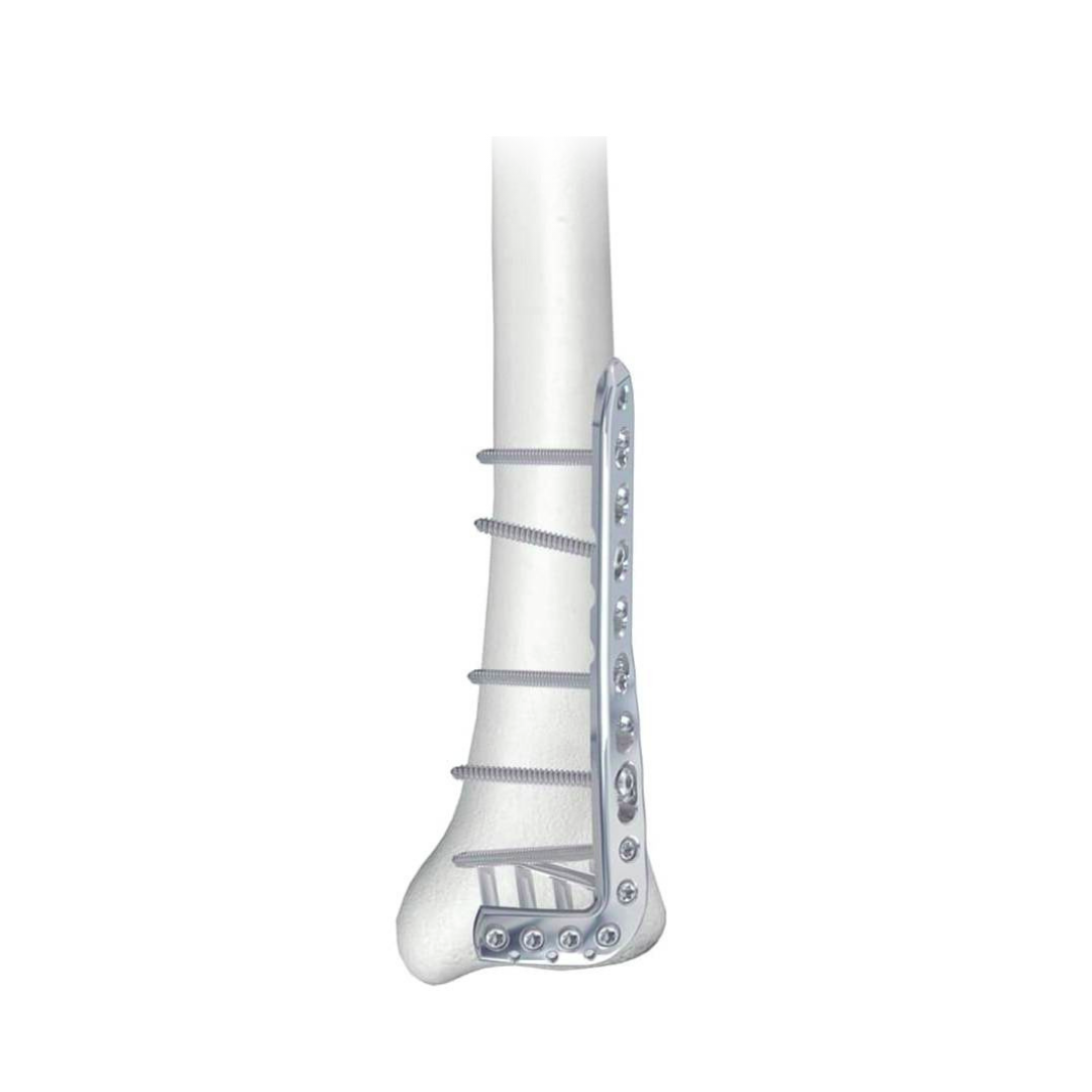 Ø3.5MM Anterolateral Distal Tibia LCP