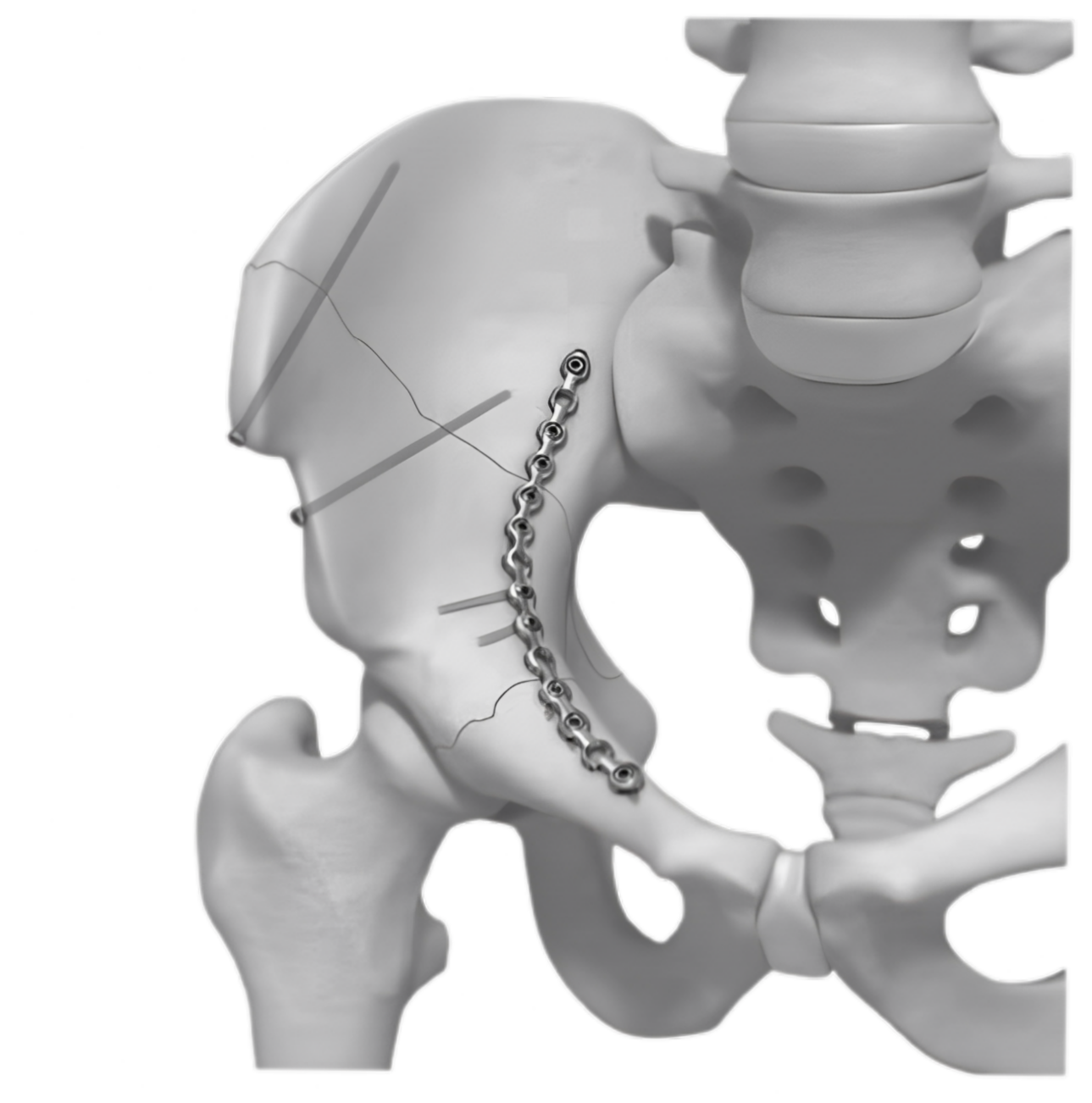 Ø3.5MM Curved Pelvic LCP