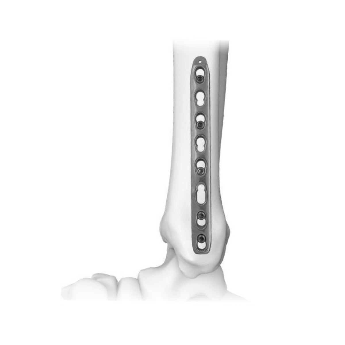 Ø3.5MM Metaphyseal LCP