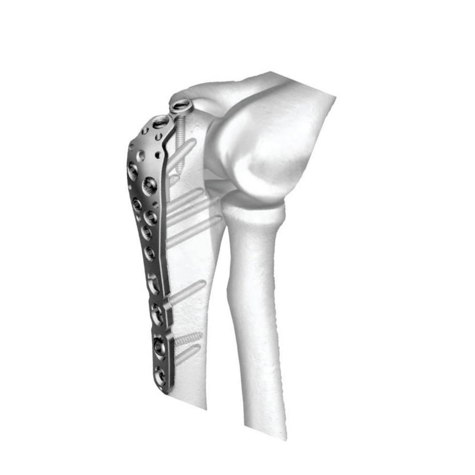 Ø3.5MM Olecranon LCP 4