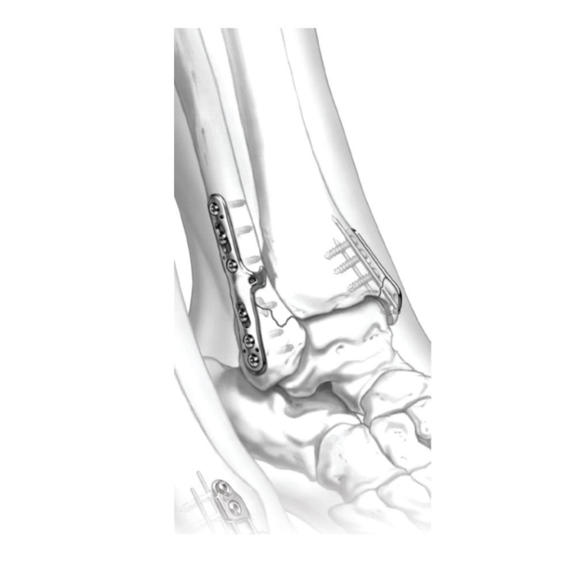 Ø3.5MM Sidewinder LCP 2