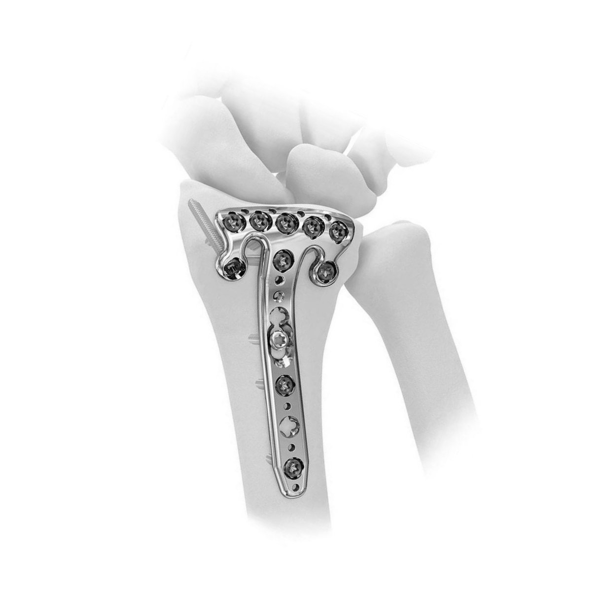 Ø3.5MM Volar Rim Distal Radius 3