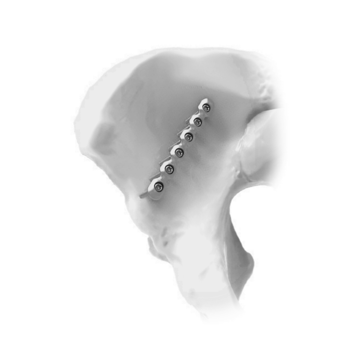 Ø3.5MM pelvic Straight LCP