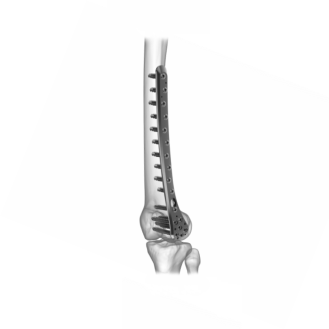 Ø5.0MM Antero Medical Distal Femur LCP