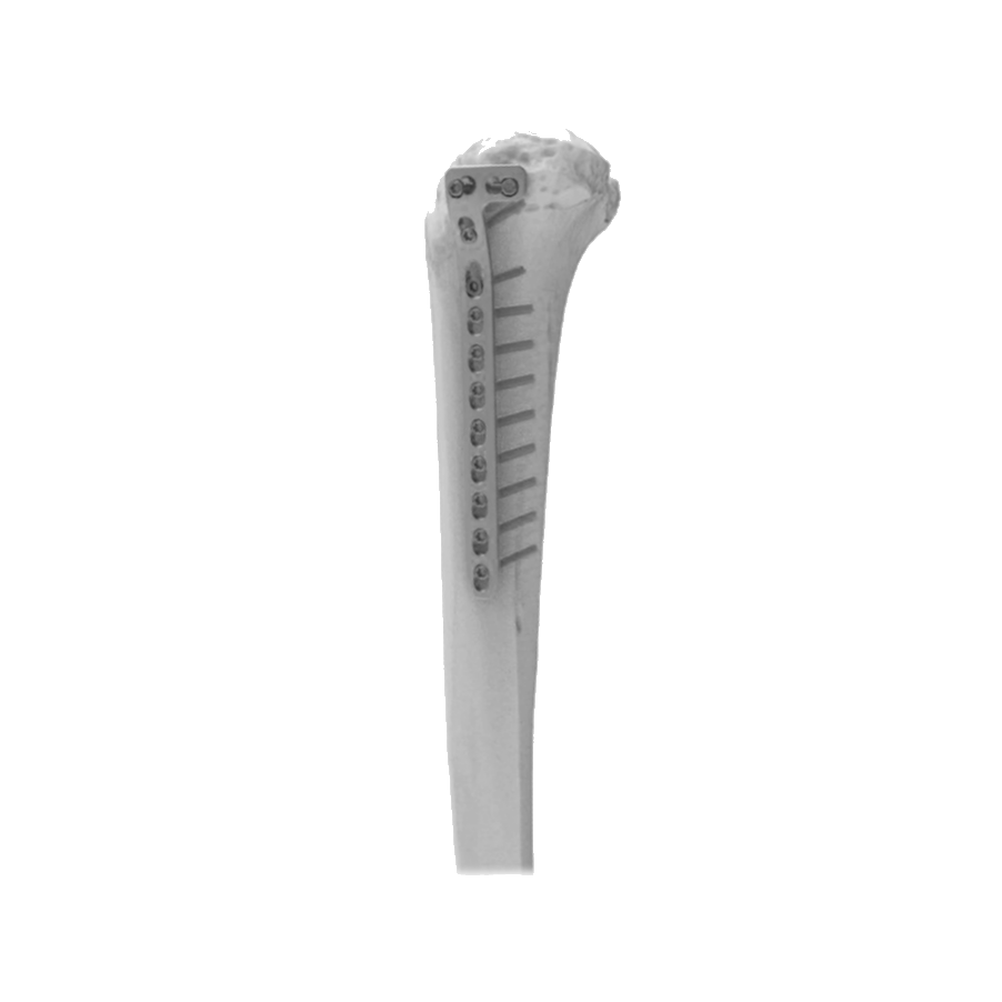 Ø5.0MM L Buttress LCP