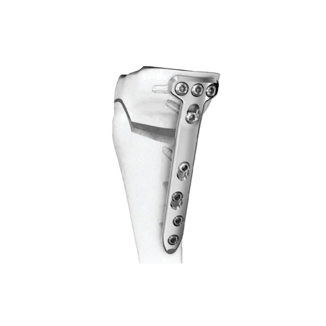 Ø5.0MM Medial High Tibia LCP