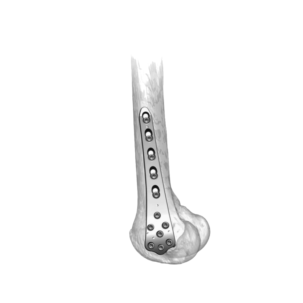 Ø5MM Lateral Distal Femur LCP