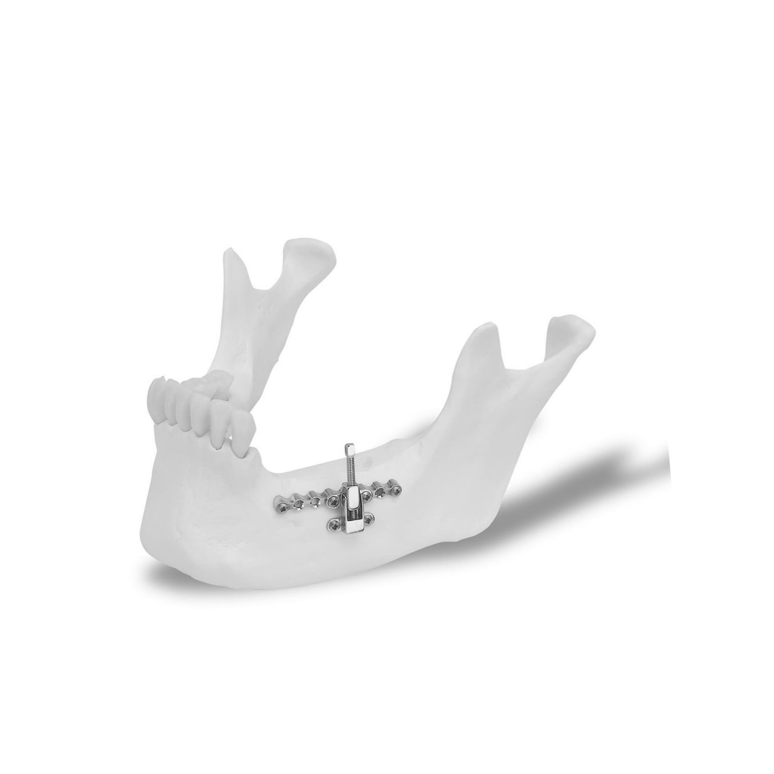 25.Alveolar Vertical Distractor (2)