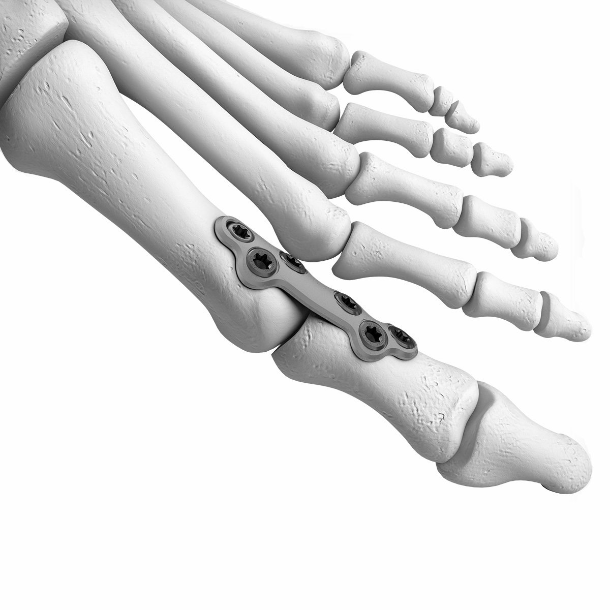 4 FIRST TMT FUSION PLATE 3