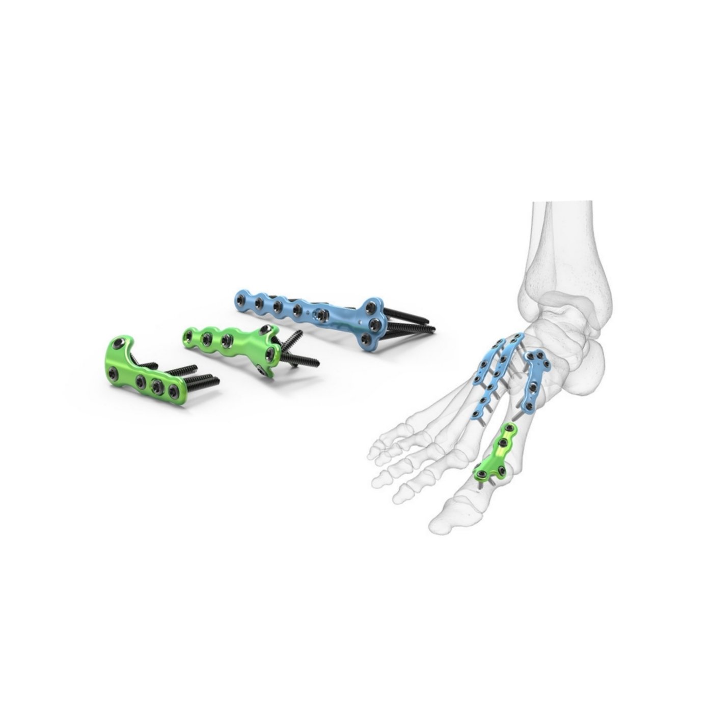 5 SECOND TMT FUSION PLATE 3