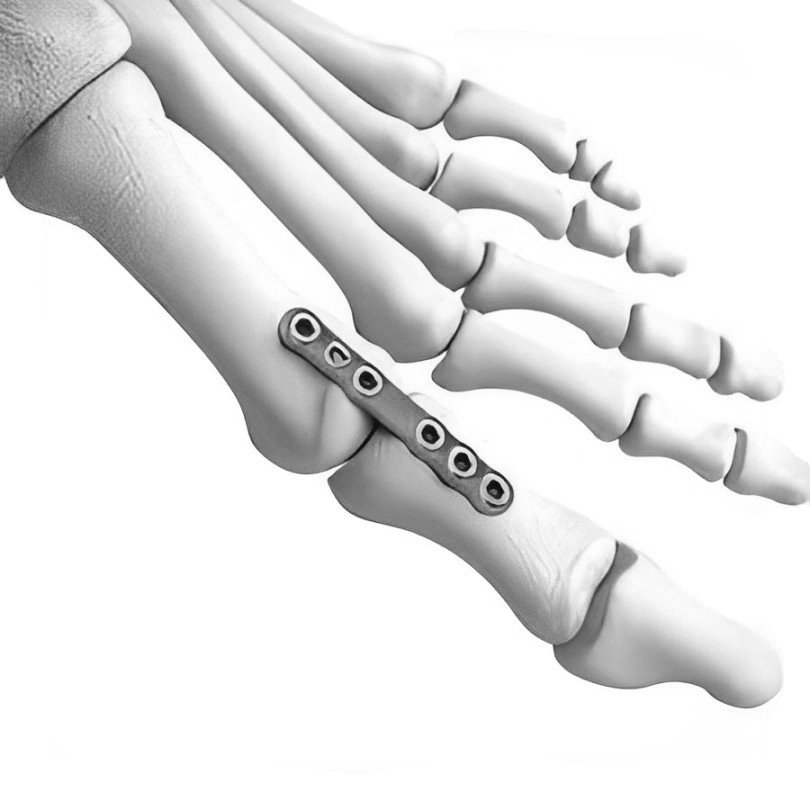 9 STRAIGHT FUSION PLATE 6