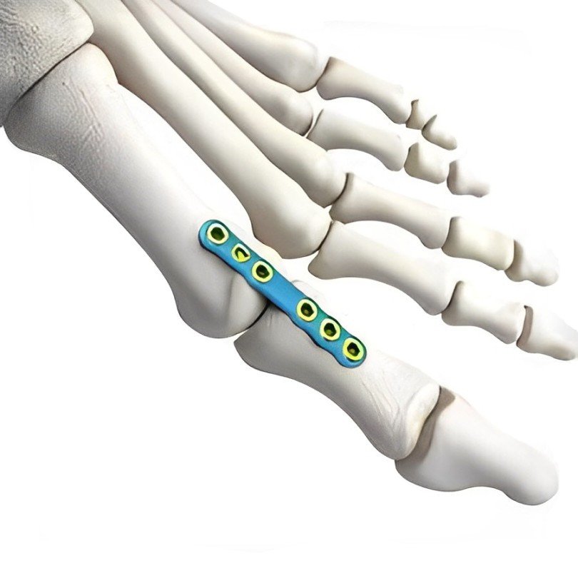 9 STRAIGHT FUSION PLATE 9