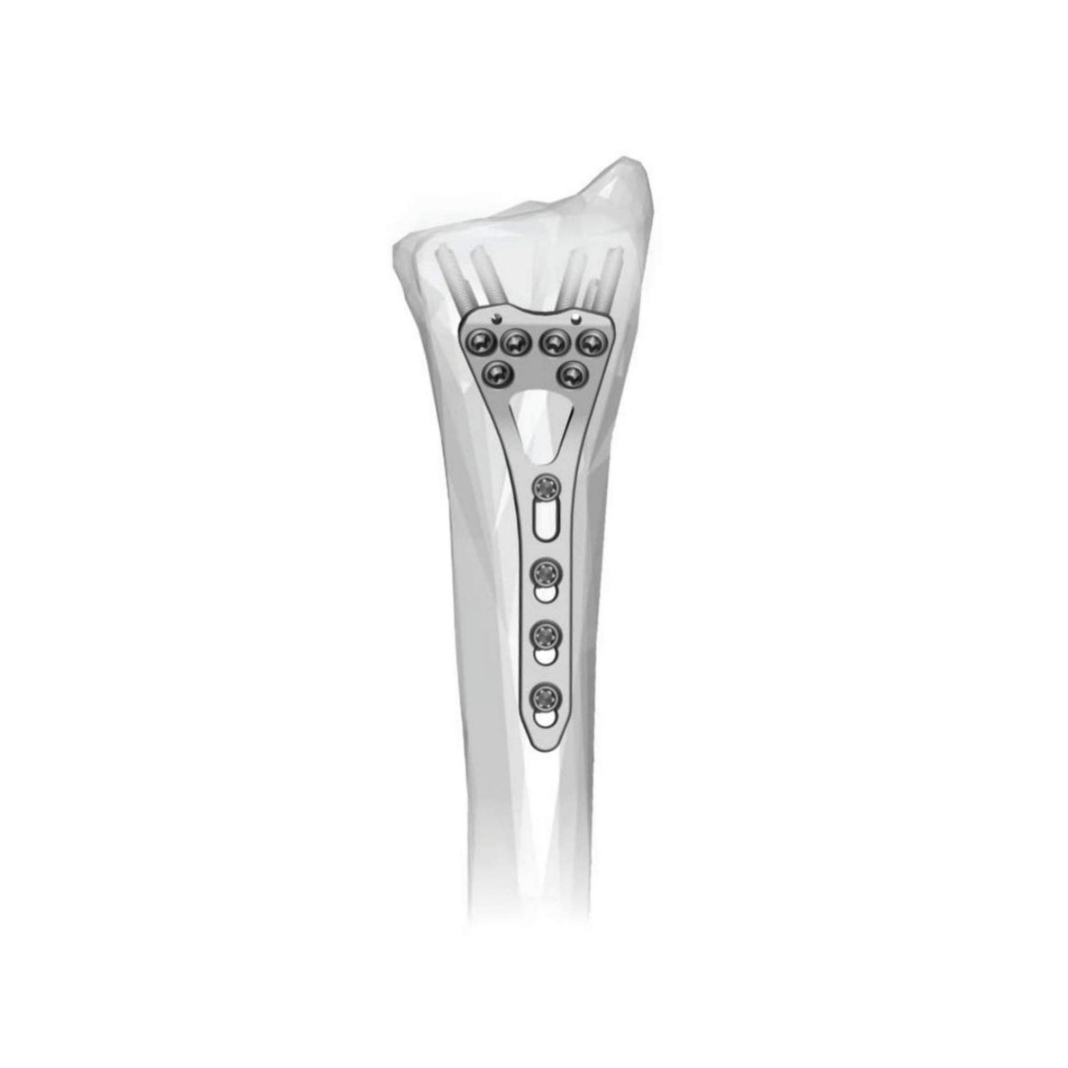 18. TWO-COLUMN DISTAL RADIUS LCP VOLAR 2.7MM 9