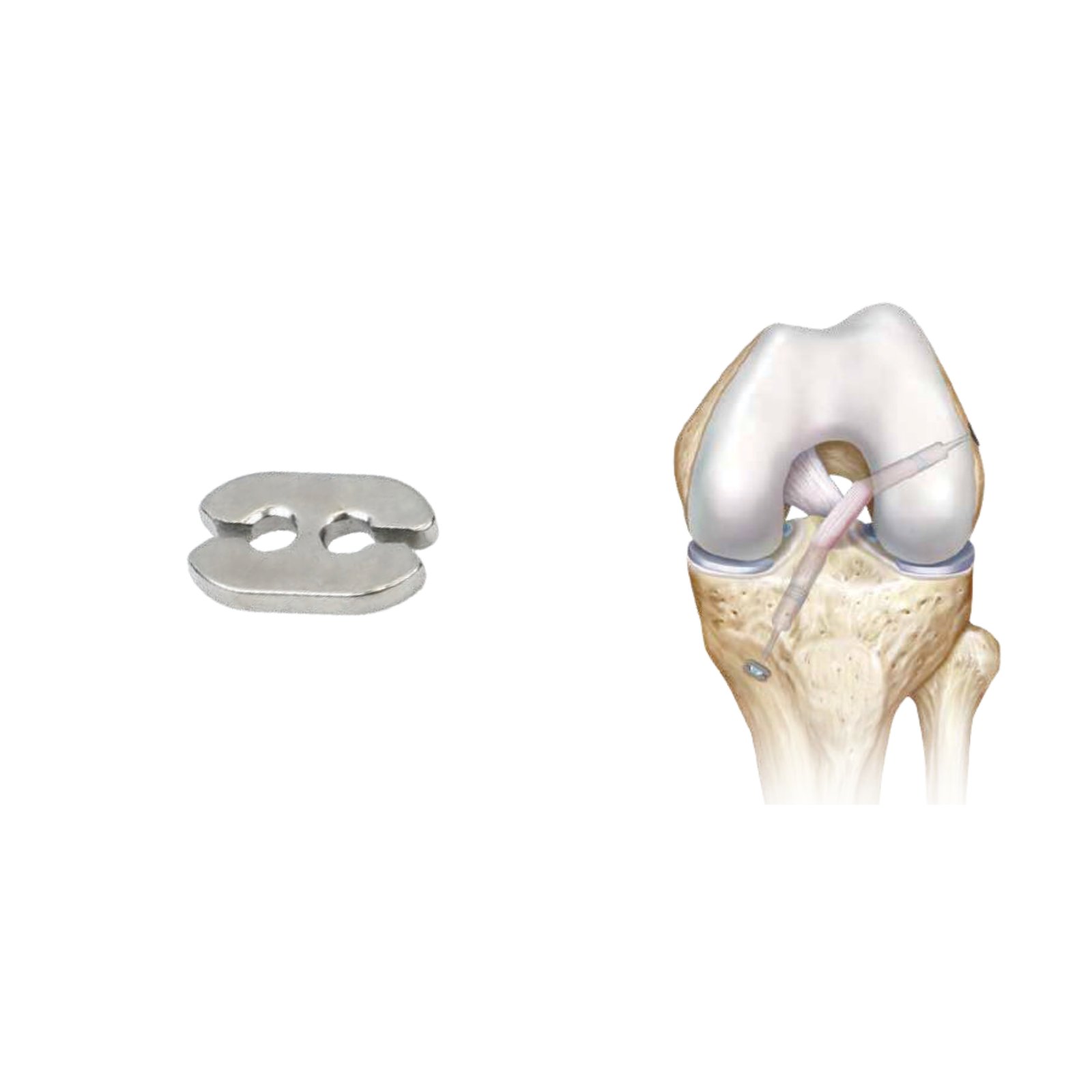 ADJUSTABLE LOOP ABS BUTTON (P11)