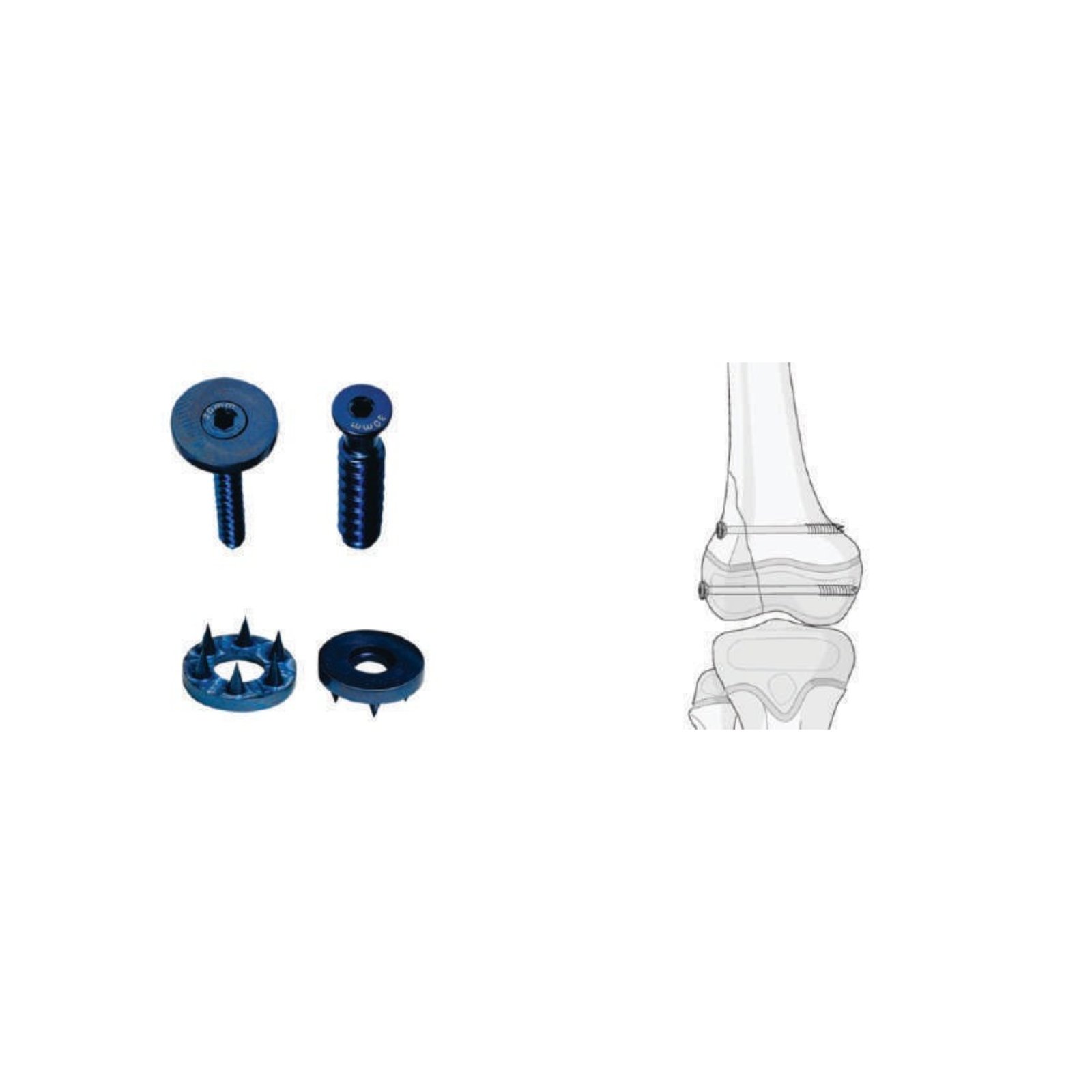 LOW PROFILE CANCELLOUS SCREW & SPIKE WASHER (P20)