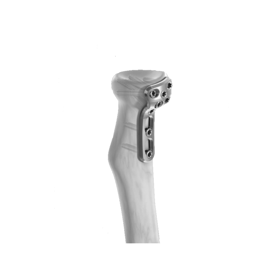 Ø2.7MM Proximal Radius Rim LCP 3
