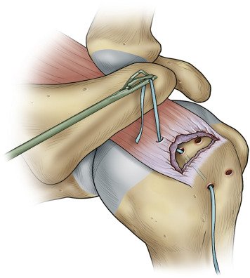 RETROGRADE ALL SUTURE ANCHOR ROTATOR CUFF