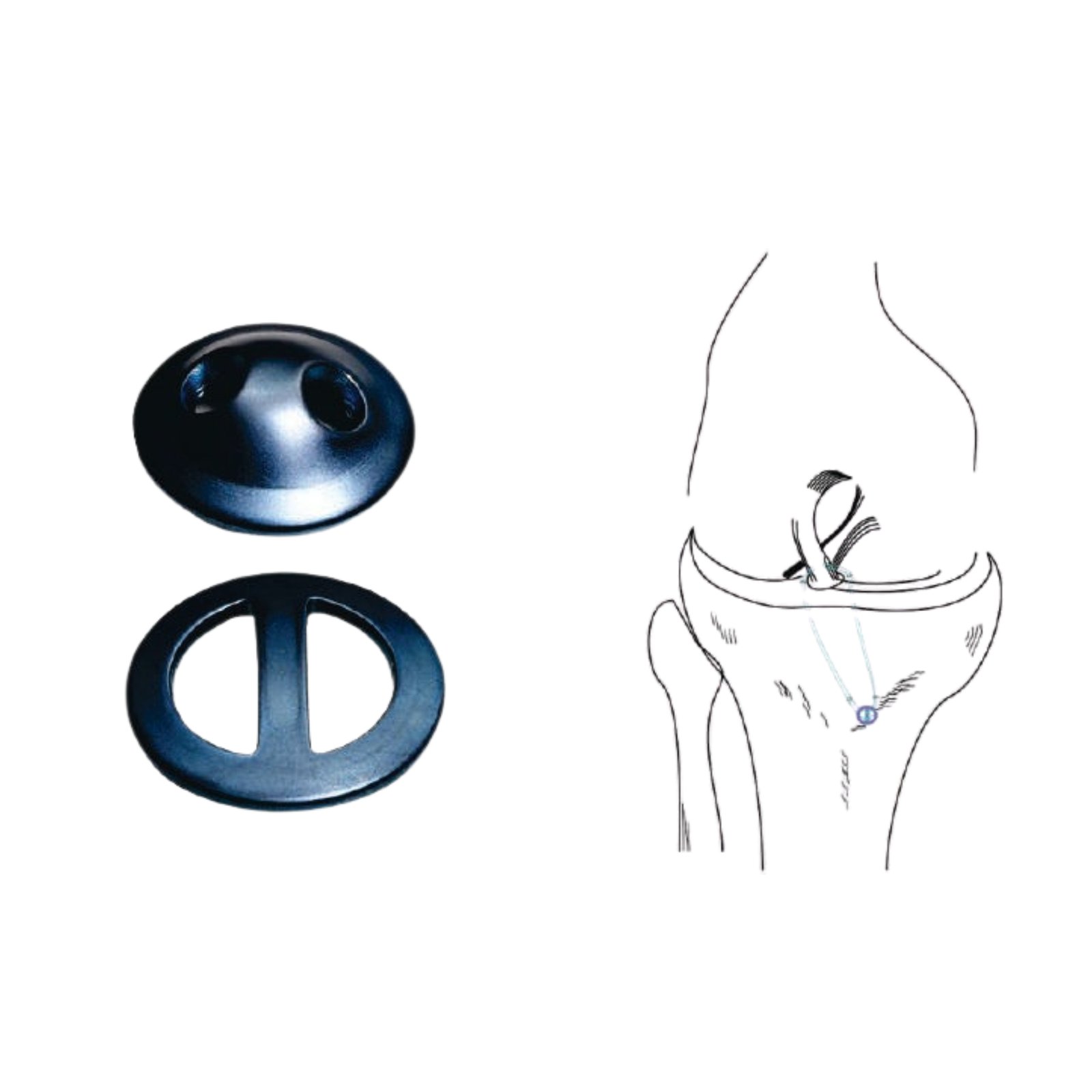 TIBIAL SUTURE DISC (P9)