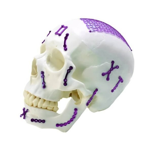maxillofacial implants